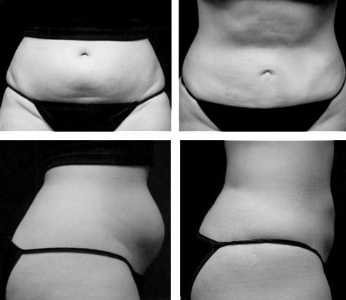 Liposcultura addome